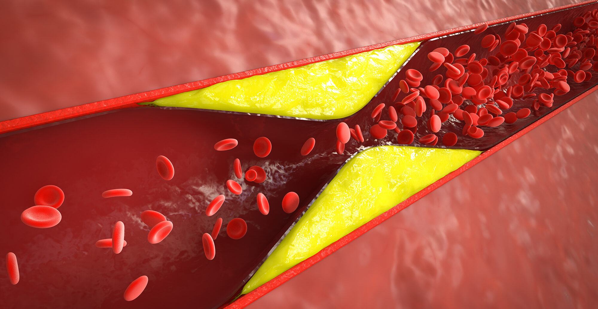 Gefäßverengung Anschauung