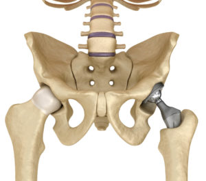 Endoprothesen Anschauung