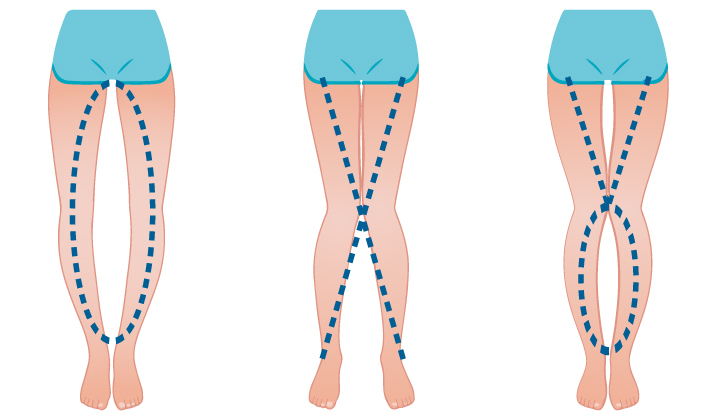 Anschauung Fehlstellung