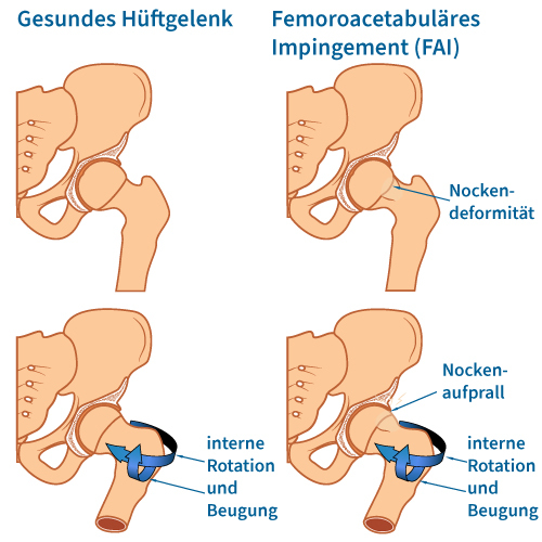 Hüft-Impingement Anschauung