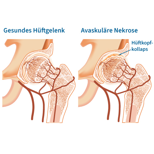 Hüftkopfnekrose Anschauung