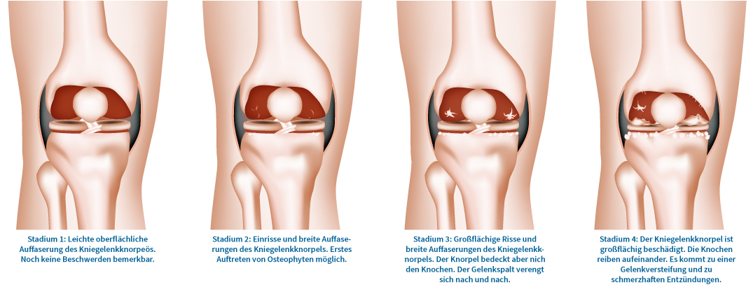Anschauung Arthrose