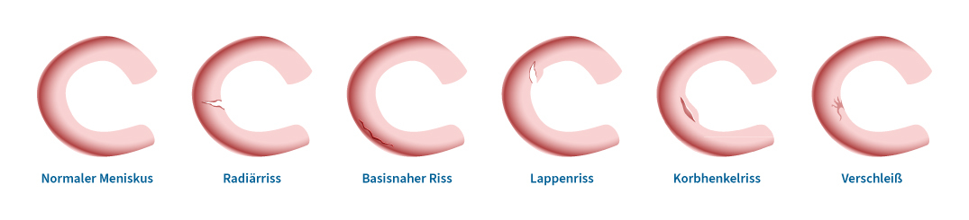 Anschauung Meniskusriss