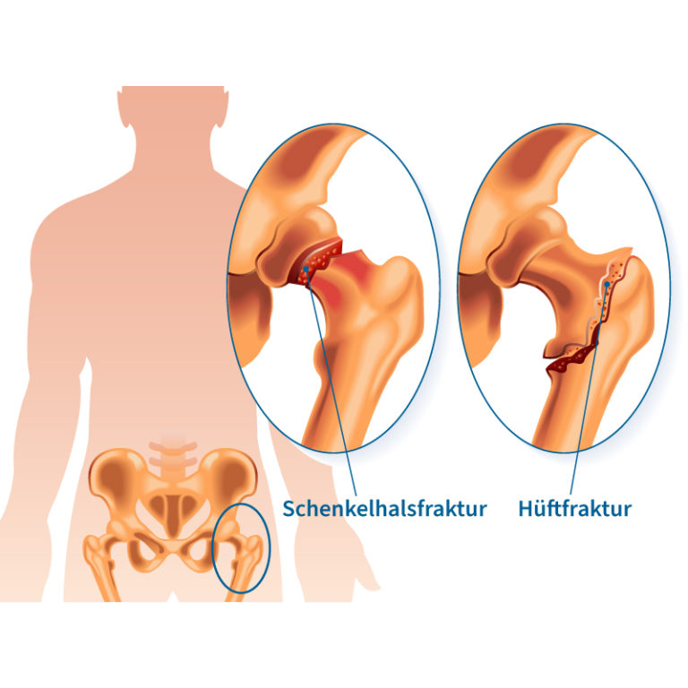 Oberschenkelhalsbruch Anschauung