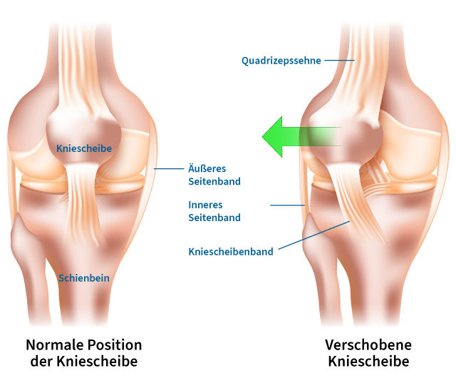 Anschauung verschobene Knieachse