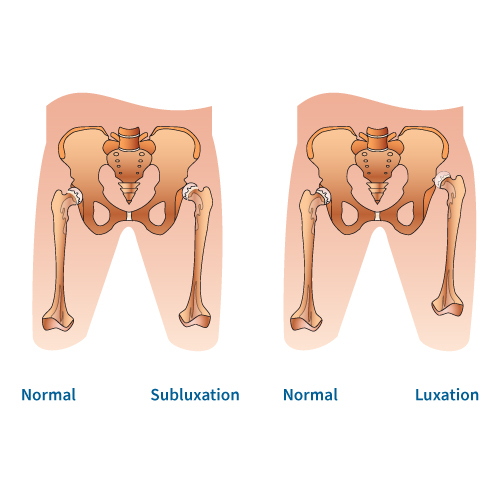 Grafik Hüftdysplasie
